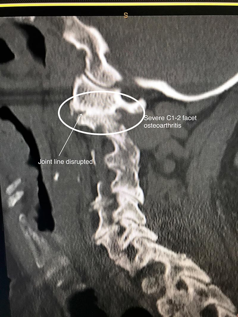 C1-2 Pain: Barely Able To Move