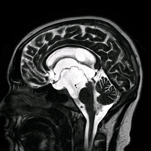 Arachnoid Cyst: A Ticking Time-bomb