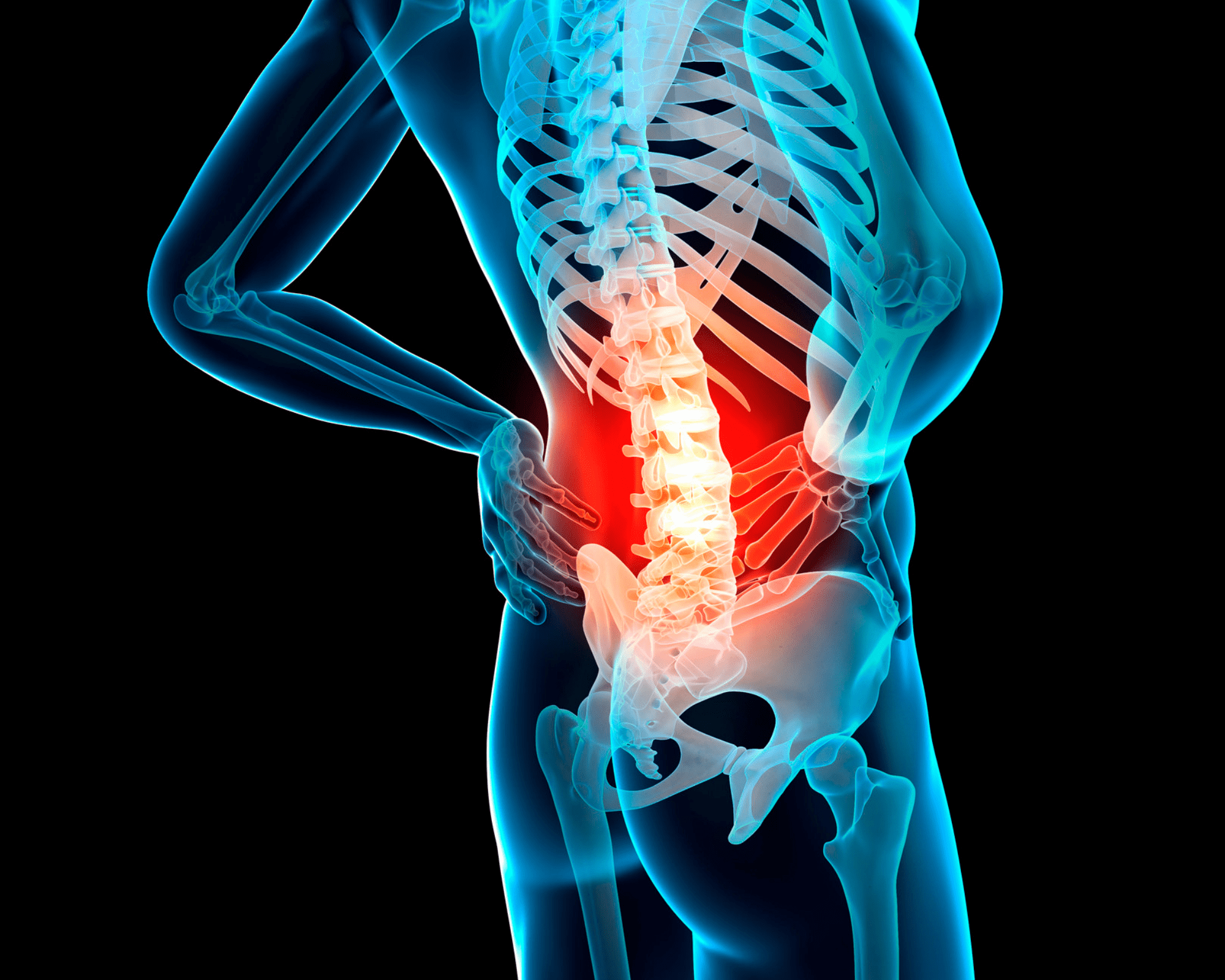 High Preoperative Expectations of Decompression Plus Fusion for Lumbar Degenerative Spondylolisthesis
