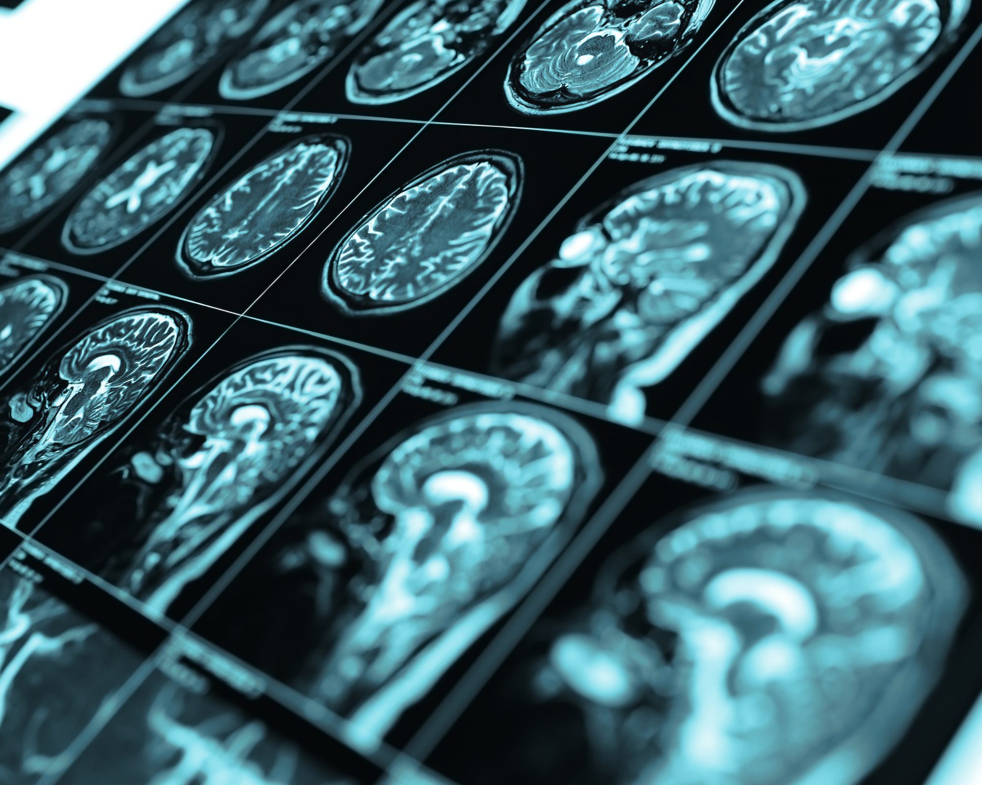 First-pass effect or rule of three? Definition of procedural success remains imperfect in stroke thrombectomy