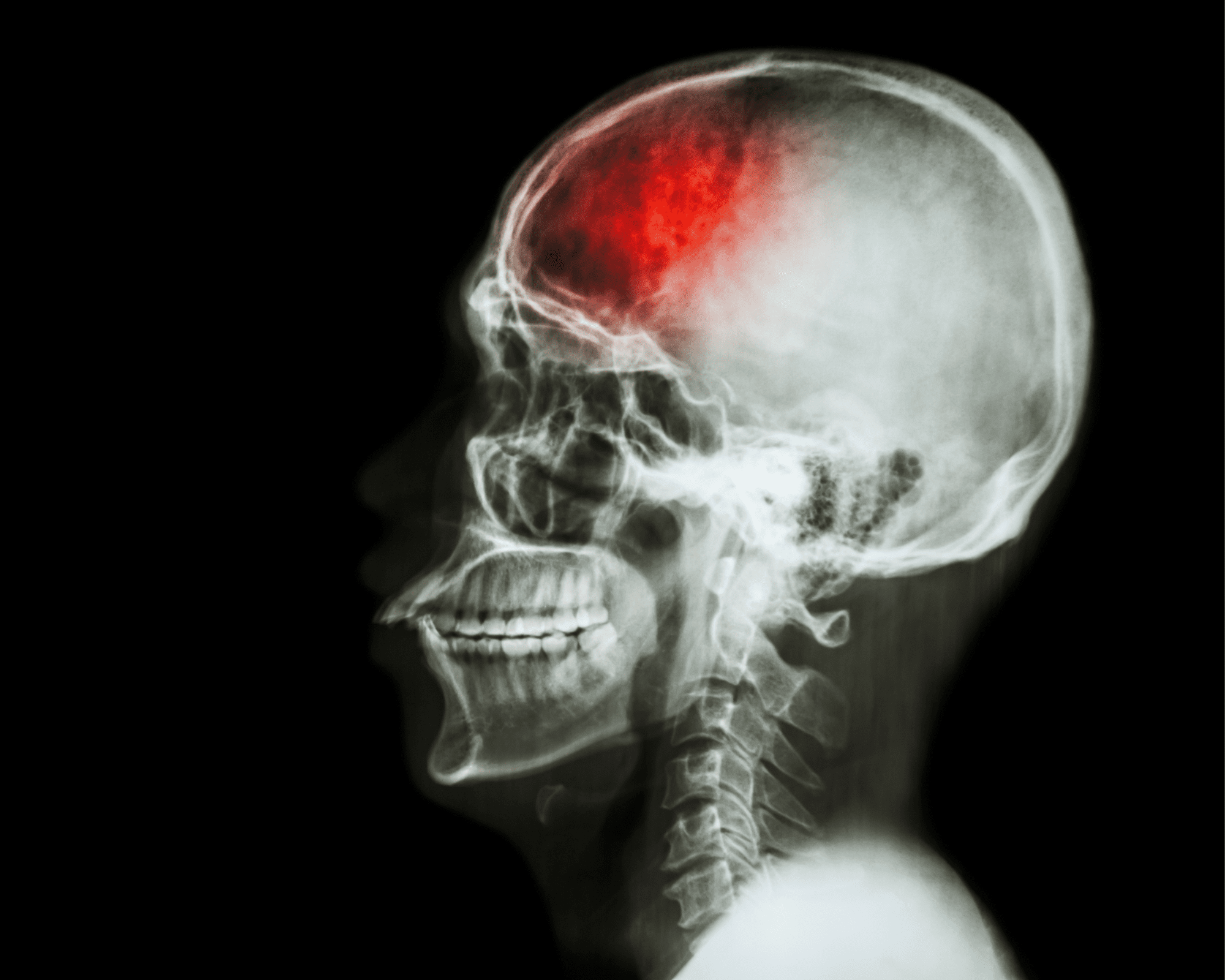 Observational study addresses ‘ongoing debate’ around intervention in asymptomatic carotid patients